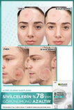 Garnier Pure Active: Anti-Acne Pore Strips with Salicylic Acid & Tea Tree Oil - Blackhead Remover, Facial Cleanser (22 Strips)